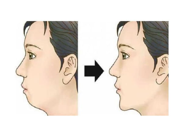 Tướng cằm ngắn là gì?