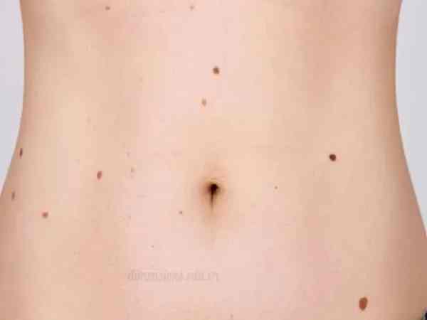 Nốt ruồi ở bụng nói lên điều gì?