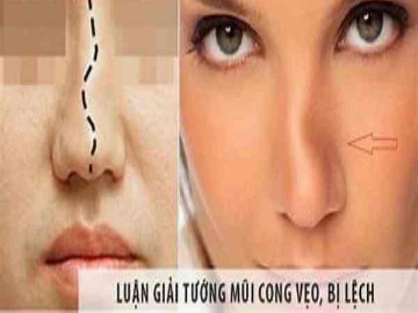 Mũi lệch, mũi vẹo nghèo