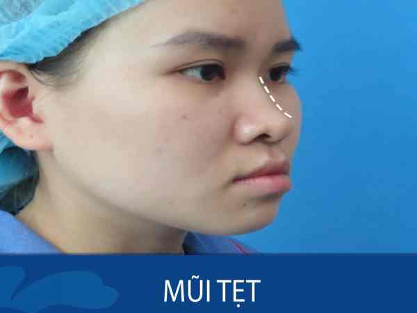 Mũi tẹt (mũi thấp)
